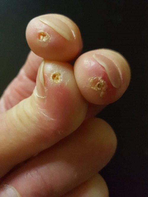 Denise Elmerin sormihaavat (3)