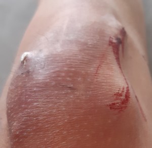 Tämän kuvan alt-attribuutti on tyhjä; Tiedoston nimi on kalsinoosit-ja-ihon-varimuutos-polvessa-e1605959612288.jpg